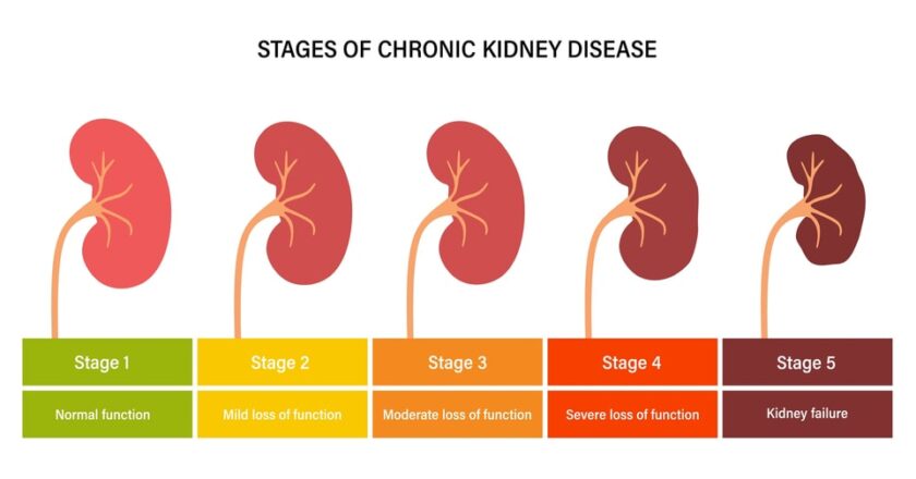 Stage 4 Chronic kidney disease: Symptoms & Treatment