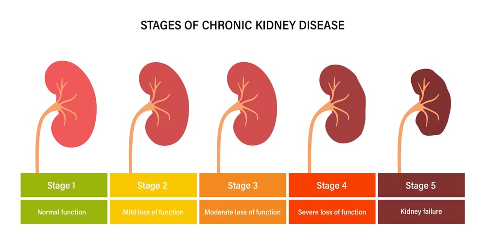 Stage 4 Kidney Disease Symptoms and Treatment
